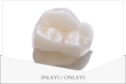 INLAYS / ONLAYS