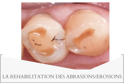 LA REHABILITATION DES ABRASIONS/EROSIONS
