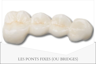 LES PONTS FIXES (OU BRIDGES)