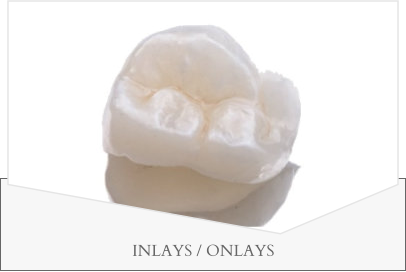 INLAYS / ONLAYS