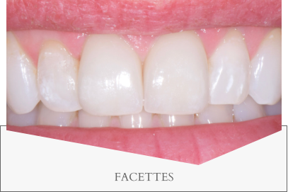 FACETTES