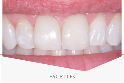 FACETTES